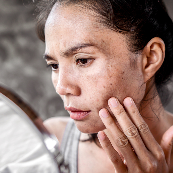 Pigmentation