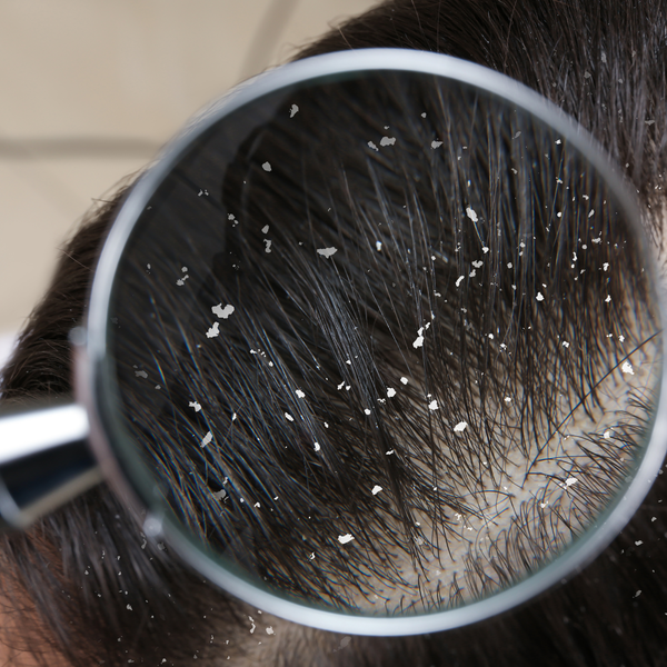 Dandruff